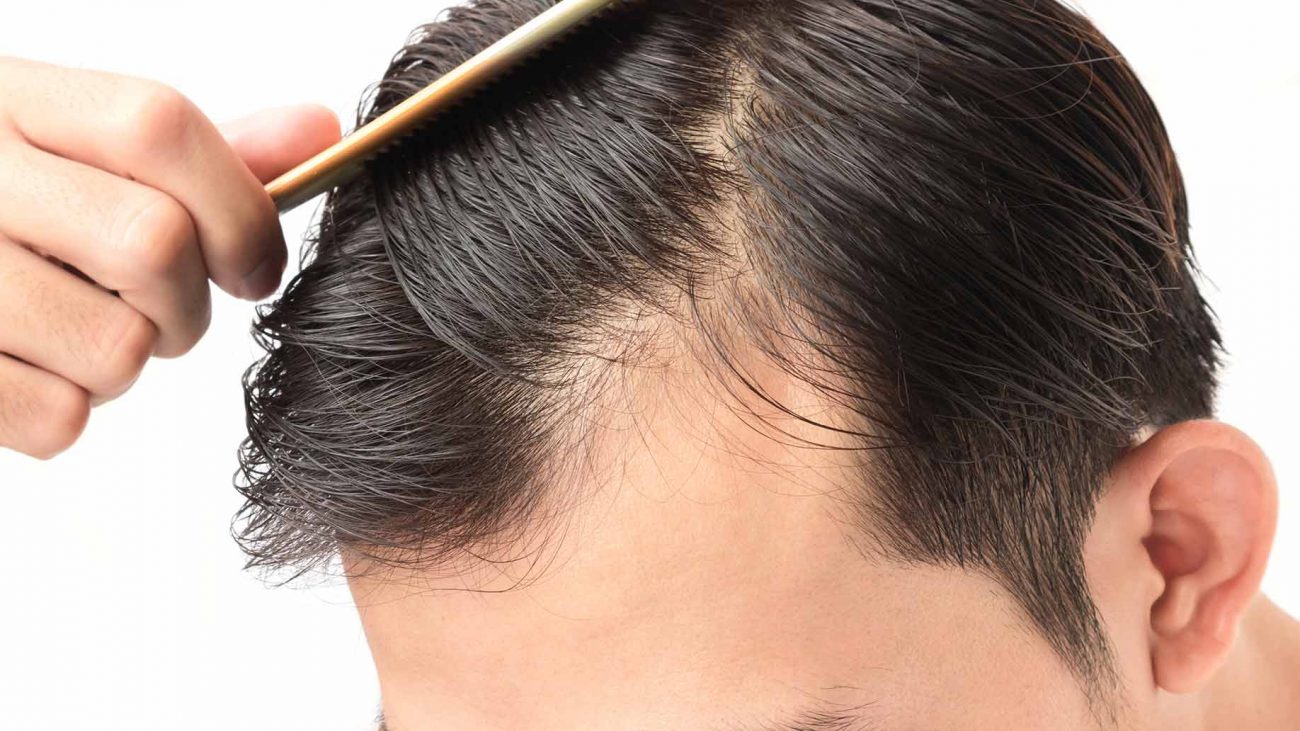 How To Reduce Hair Loss In Men The Cook Book